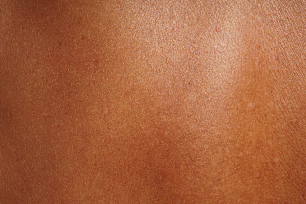 couleur peau lumiere pulsee