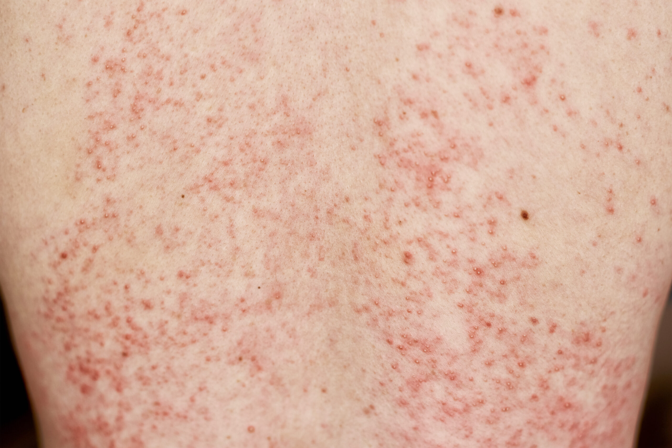 Rosacea on the skin