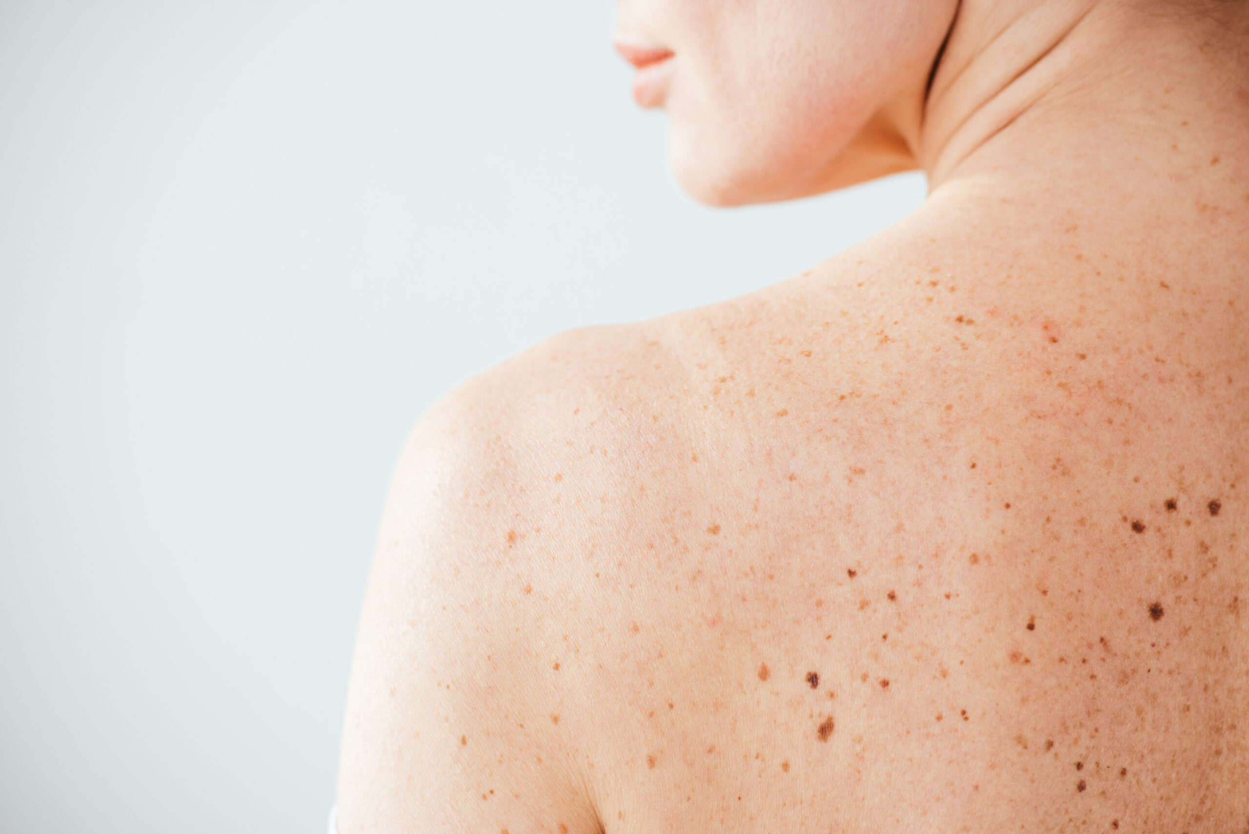 Woman’s back, skin possibly at risk of cancer from pulsed light