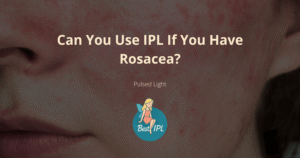 ipl rosacea