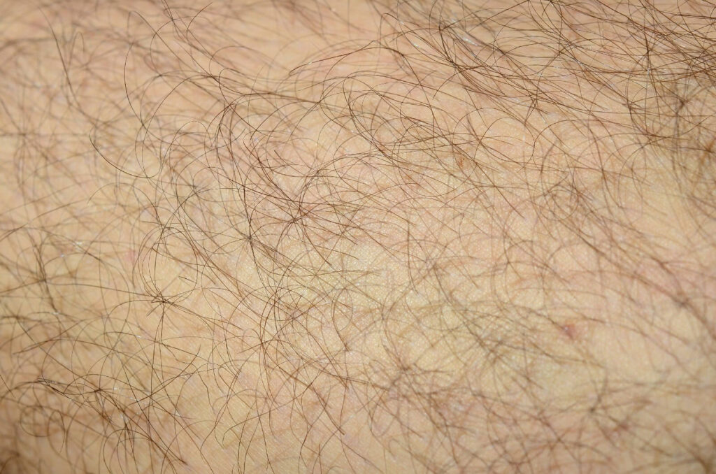 poil noir intensitee lumiere pulsee 1