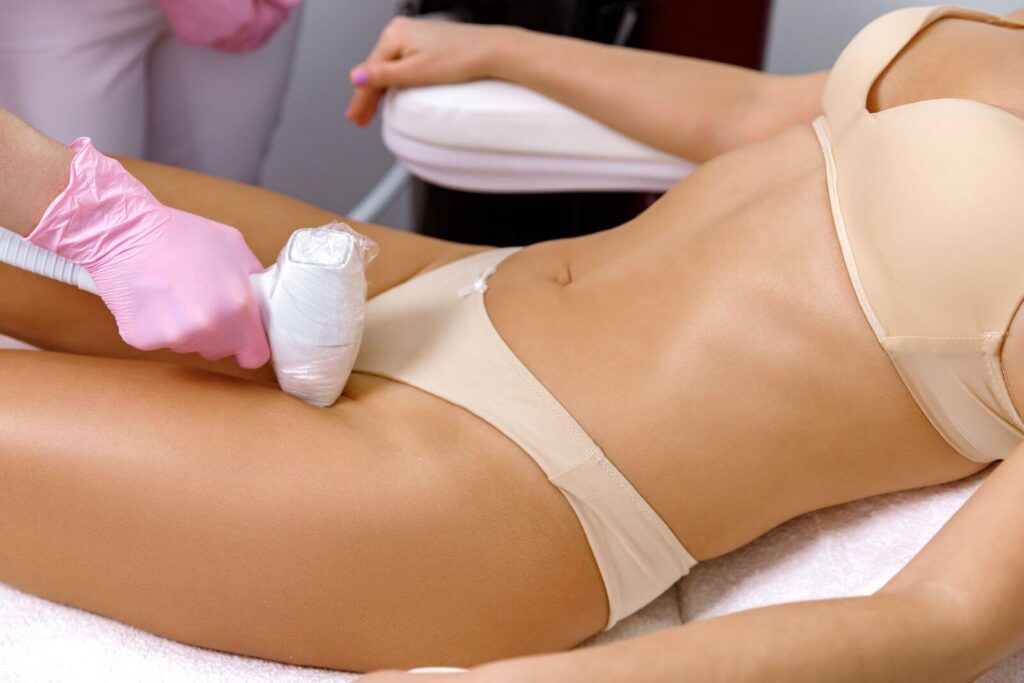 IPL treatment on bikini area