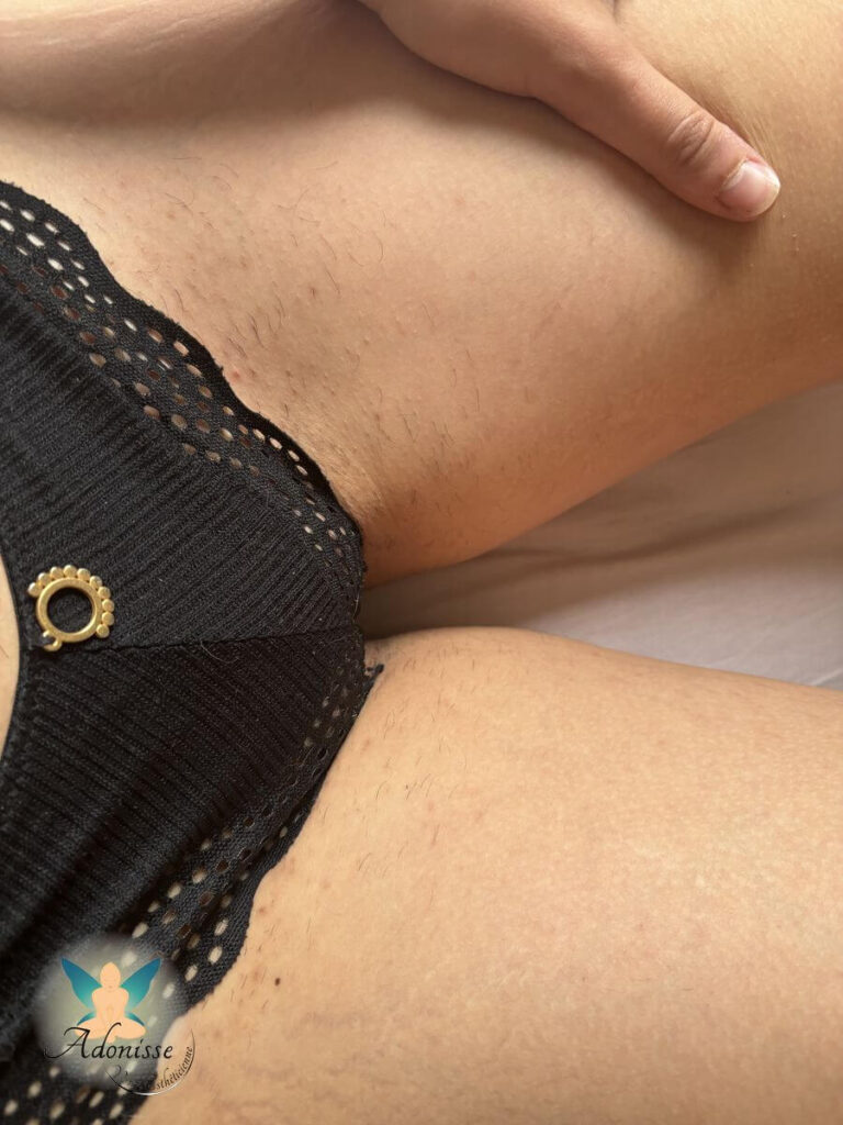 maillot lumiere pulsee 1 mois apres 4 seances 3